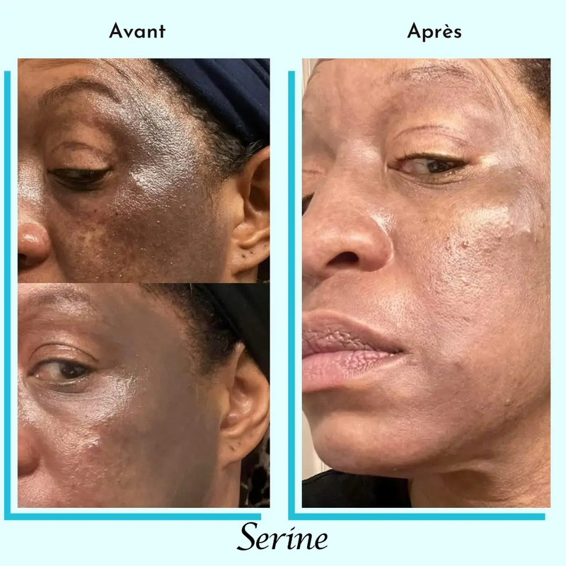 Aïssatou — before and after