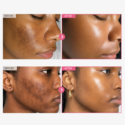 Alpha Arbutin + TXA Cream