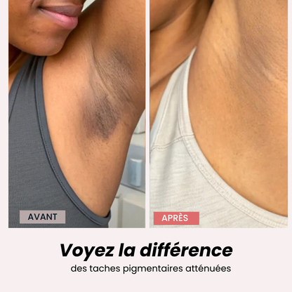 Hyperpigmentation Anti-Taches