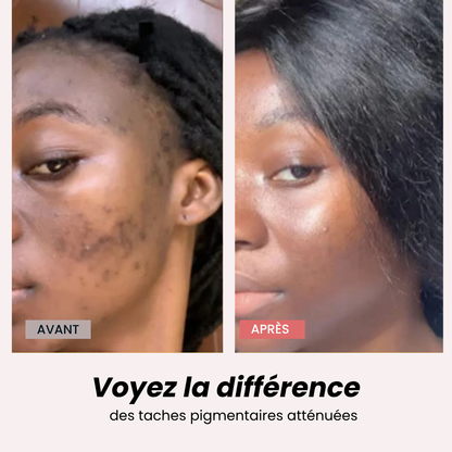 Hyperpigmentation Anti-Taches