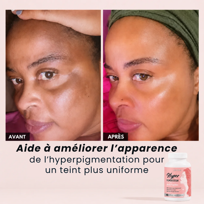 Hyperpigmentation Anti-Taches