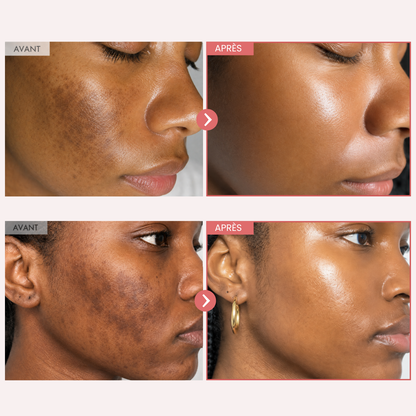 Hyperpigmentation Anti-Taches